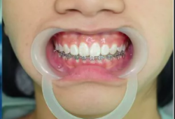 BẢNG GIÁ NIỀNG RĂNG