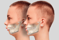 Chi phí niềng răng hô tại quận Tân Phú mới nhất 2025