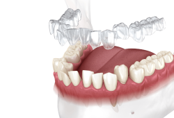 Chỉnh nha invisalign và những điều cần biết