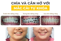 Giải pháp niềng răng 2 hàm hiệu quả tại nha khoa Cát Tiên