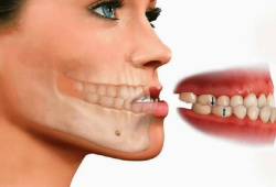Bị móm có nên niềng răng không? Có hiệu quả thật không?