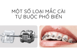 Những điều bạn cần biết trước khi niềng răng với mắc cài tự buộc
