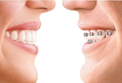 Giá niềng răng trong suốt rẻ nhất 2025 tại quận Tân Phú
