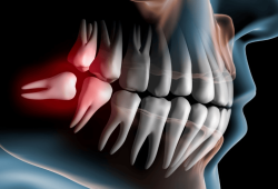 Nha khoa nhổ răng khôn tại Tân Phú được đánh giá cao – Cát Tiên Dental