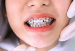 Niềng răng chen chúc - Nguyên nhân và phương pháp điều trị