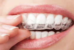 Top 3 ưu điểm vượt trội của phương pháp niềng răng không mắc cài