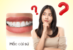 Niềng răng mắc cài sứ - Phương pháp chỉnh nha cho người yêu thẩm mỹ