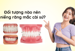 Niềng răng mắc cài sứ giá bao nhiêu? Cần lưu ý gì khi niềng răng mắc cài sứ?