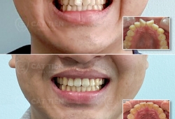 Chỉnh nha - Phương pháp hiệu quả để cải thiện răng miệng và tăng sự tự tin