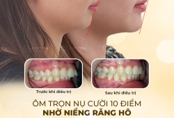Niềng răng 1 hàm - Giải pháp hiệu quả và tiết kiệm cho răng sai lệch nhẹ