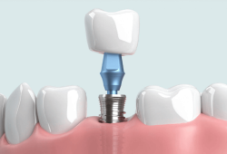 Cát Tiên Dental - Địa điểm trồng răng implant tại Tân Phú uy tín, được đánh giá tốt nhất 2024