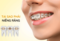 Nha khoa niềng răng quận Tân Phú tốt nhất 2024