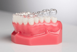 Bảng giá niềng răng trong suốt mới nhất tại Cát Tiên Dental