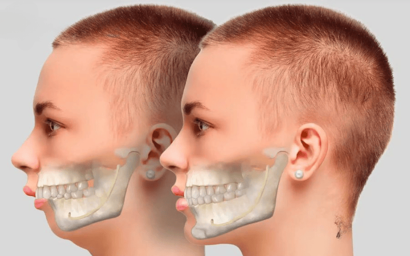 Niềng răng giúp khắc phục tình trạng hô hàm