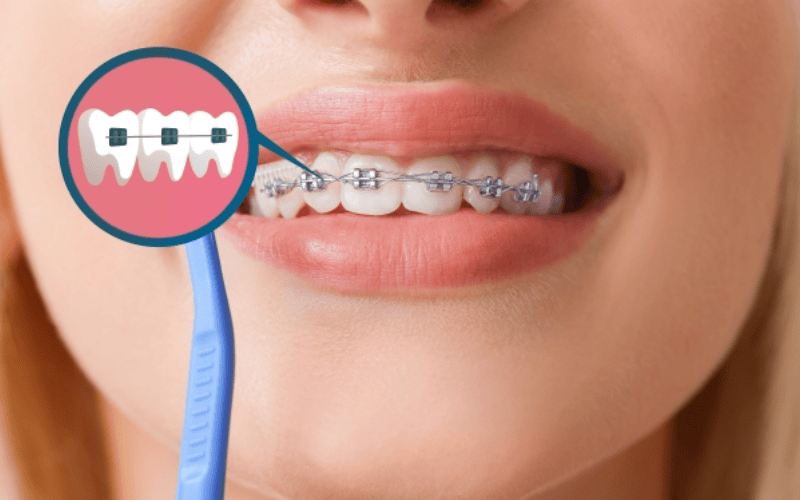 Ưu điểm của niềng răng  