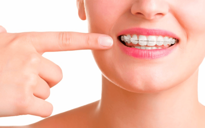 Lưu ý khi niềng răng mắc cài sứ