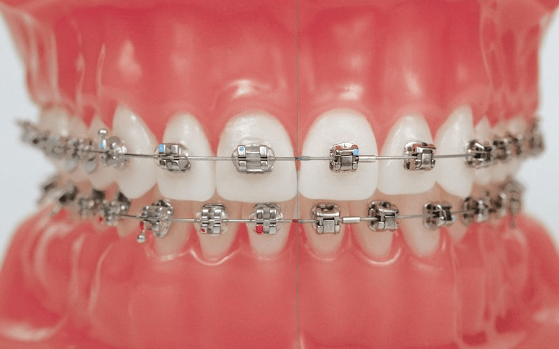 Niềng răng mắc cài