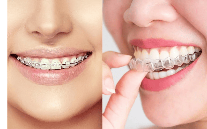 Nên niềng răng mắc cài hay khay trong suốt