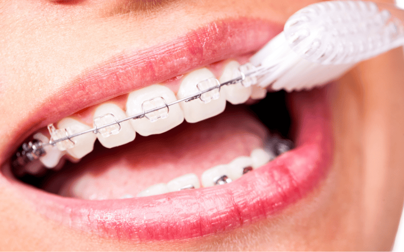 Cách chăm sóc sau khi niềng răng mắc cài sứ