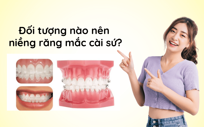 Đối tượng nào nên niềng răng mắc cài sứ