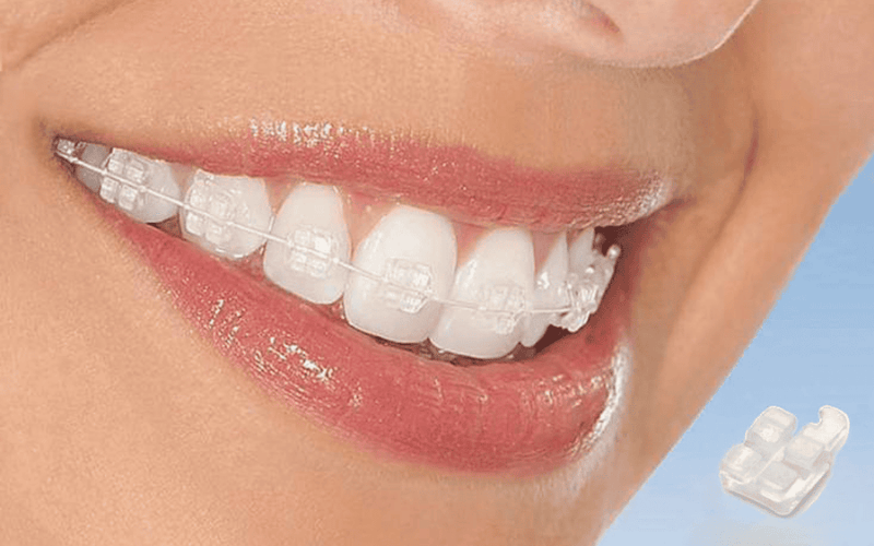 Niềng răng mắc cài sứ