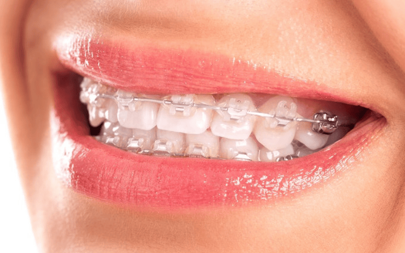 Niềng răng mắc cài sứ