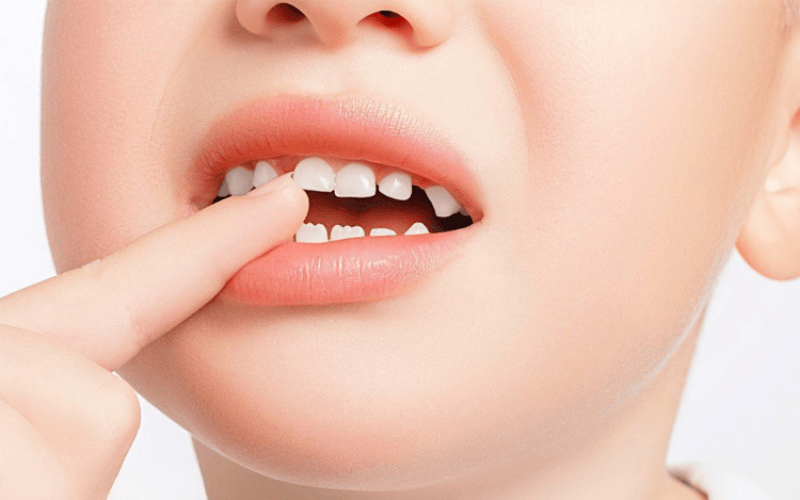 Hàm trainer giúp loại bỏ các thói quen xấu gây lệch lạc răng