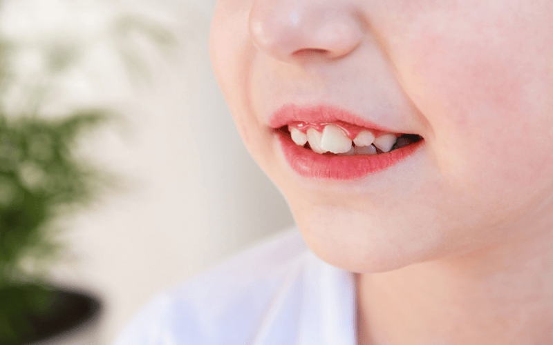 Dấu hiệu trẻ cần phải định hình răng